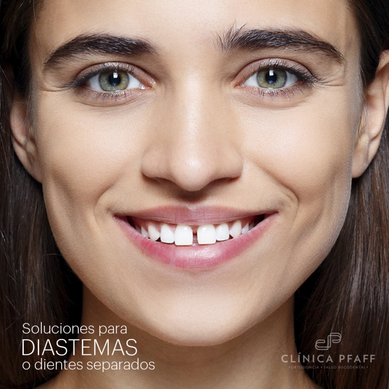 Diastemas o dientes separados. Cómo solucionarlo?