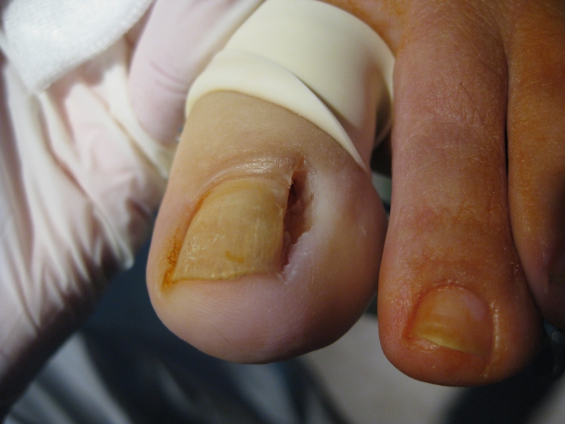 Cirugía ungueal de uñas