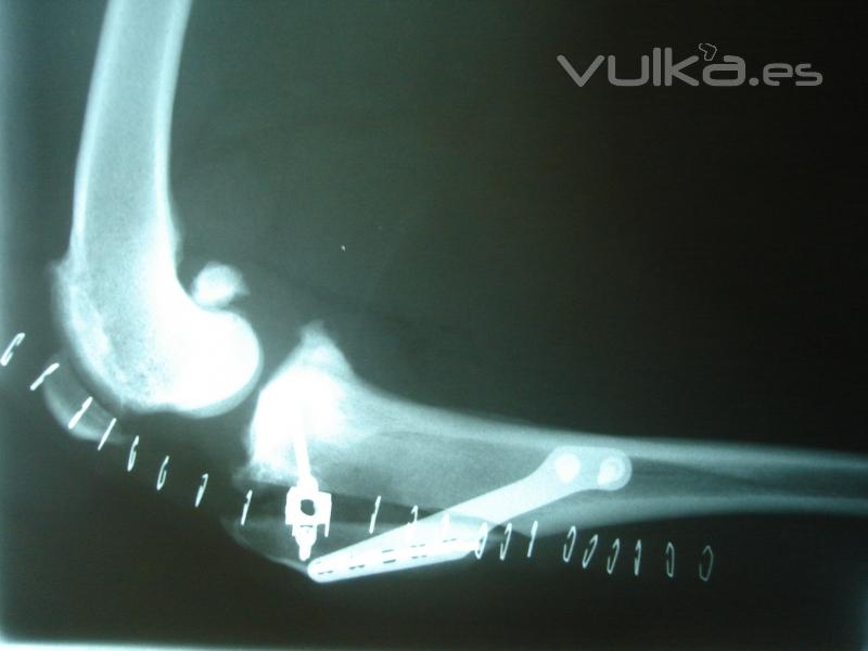 Técnica TTA pra resolución de rotura de ligamento cruzado anterior, mas información en http://www.ve