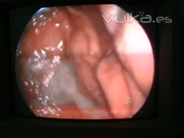 diagnstico por imagen - videoendoscopia