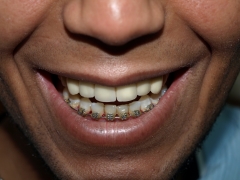 Foto 130 prtesis dentales - Calitecno Dental