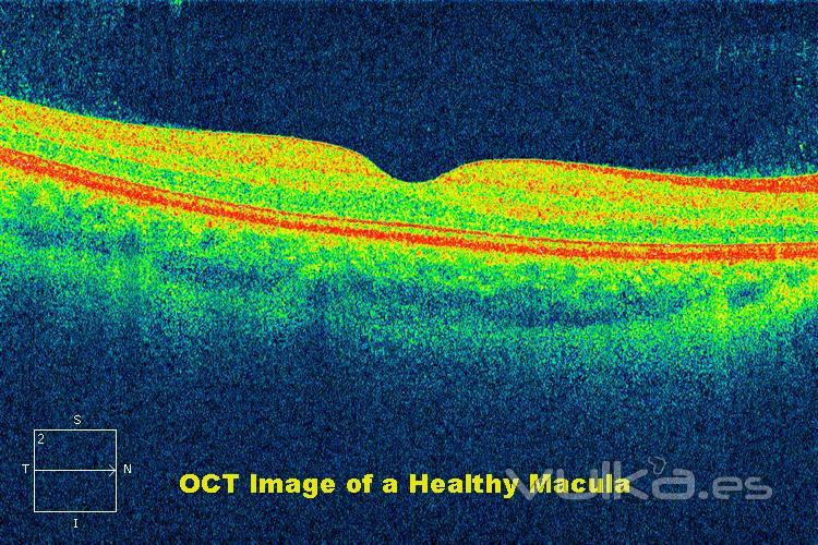 OCT DE ALTA DEFINICIÓN DE LA MÁCULA (RETINA)