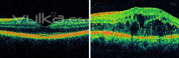 EDEMA MACULAR (OCT DE ALTA DEFINICIN)