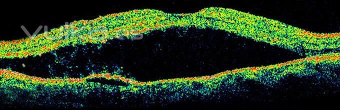 DESPRENDIMIENTO DE RETINA (imagen de OCT))