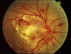 Retinopata hipertensiva (examen de fondo de ojo)