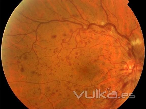 TROMBOSIS DE VENA CENTRAL DE LA RETINA (FONDO DE OJO)