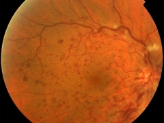 Trombosis de vena central de la retina (fondo de ojo)
