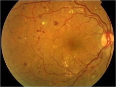 Retinopatia diabetica (fondo de ojo)