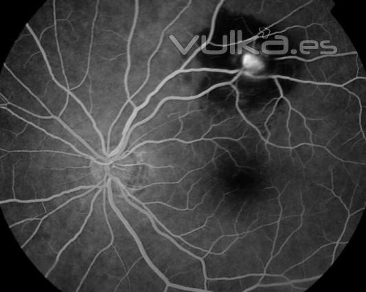 MACROANEURISMA RETINIANO (ANGIOGRAFA)