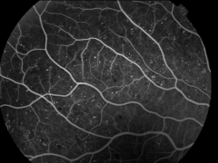 Microaneurismas retinianos (angiografa)