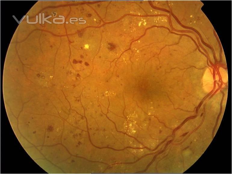 RETINOPATA DIABTICA (FONDO DE OJO)