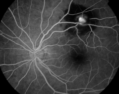 Macroaneurisma retiniano (angiografia)