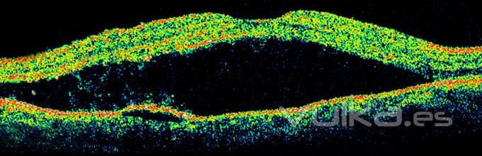 DESPRENDIMIENTO DE RETINA (IMAGEN DE OCT)