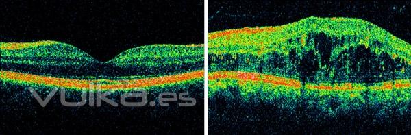 EDEMA MACULAR RETINIANO (IMAGEN DE OCT-HD CIRRUS)