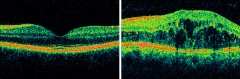 Edema macular retiniano (imagen de oct-hd cirrus)