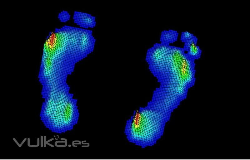 Imagen tridimensional de presiones plantares