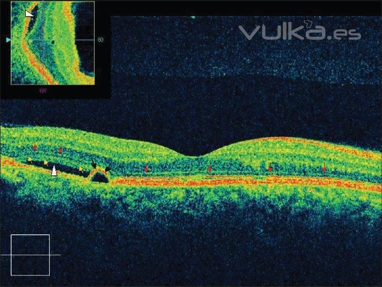 OCT RETINIANA DE ALTA RESOLUCIN MOSTRANDO DESPRENDIMIENTO DEL EPITELIO PIGMENTARIO CON EXUDACIN DE LQUIDO ...