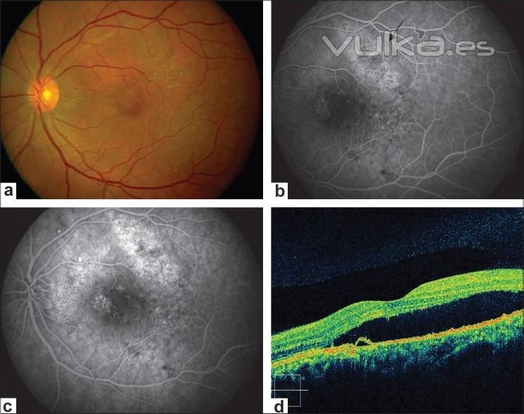COROIDOPATA SEROSA CENTRAL. IMGENES DE RETINOGRAFA, ANGIOGRAFA Y OCT DE ALTA DEFINICIN.