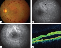 Coroidopata serosa central. imgenes de retinografa, angiografa y oct de alta definicin.