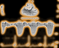 Ecocardiografa doppler continuo regurgitacin mitral , sincronizado ecg