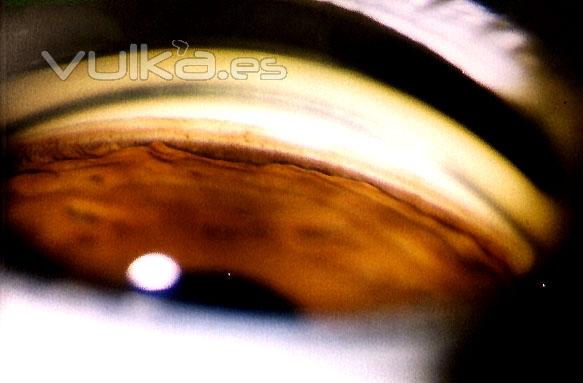 GONIOSCOPIA OCULAR (ESTUDIO DEL GLAUCOMA)