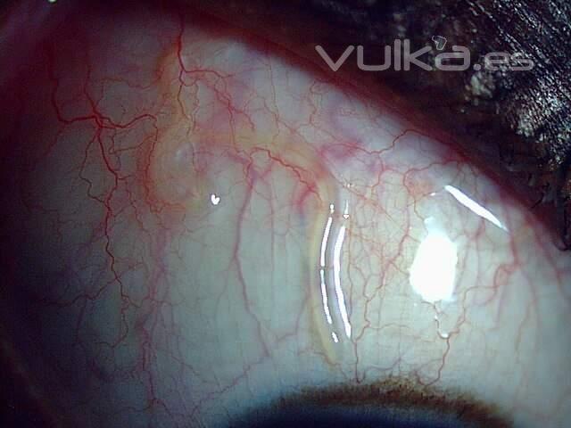 LOA-LOA CONJUNTIVAL (PARSITO)