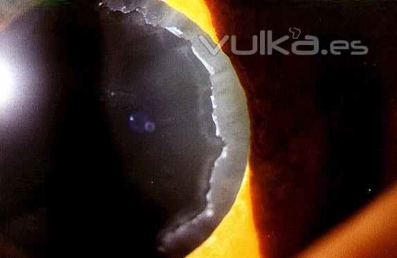 PSEUDOEXFOLIACIN DEL CRISTALINO OCULAR