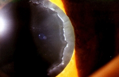 Pseudoexfoliacin del cristalino ocular