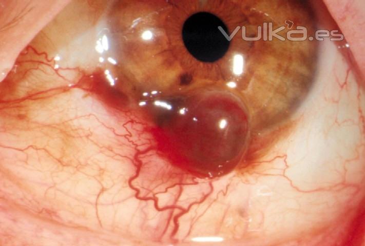 MELANOMA CONJUNTIVAL