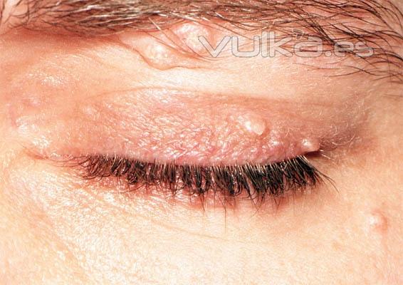 MOLLUSCUM CONTAGIOSUM EN PRPADOS (VIRUS)