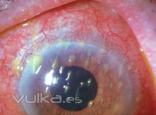 QUERATITIS FILAMENTOSA EN OJO SECO