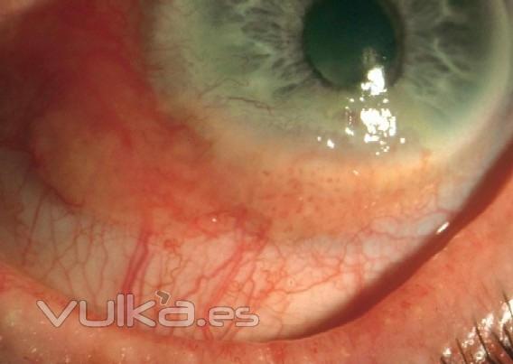 CARCINOMA IN SITU CONJUNTIVAL