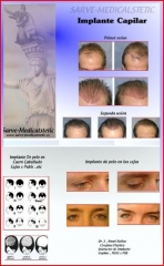Implante capilar en cuero cabelludo , cejas , pubis & etc