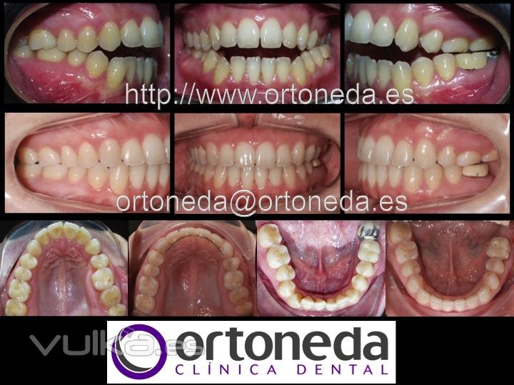 Ortodoncia adultos (Mordida abierta)