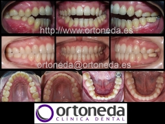 Ortodoncia adultos (mordida abierta)