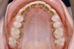 Ortodoncia lingual - incognito