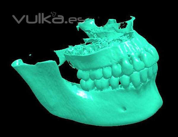 Modelo obtenido de tomografa para planificacin intervencin quirurgica