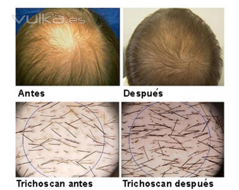 Tratamiento Capilar con Laser Antes del Tratamiento y Depues 