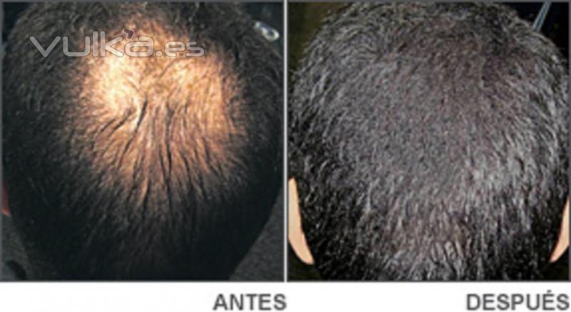 Antes y Despues de aplicar Keratin, fibras Capilares, Tenemos diferentes colores