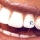 PIERCING O BRILLANTE DENTAL