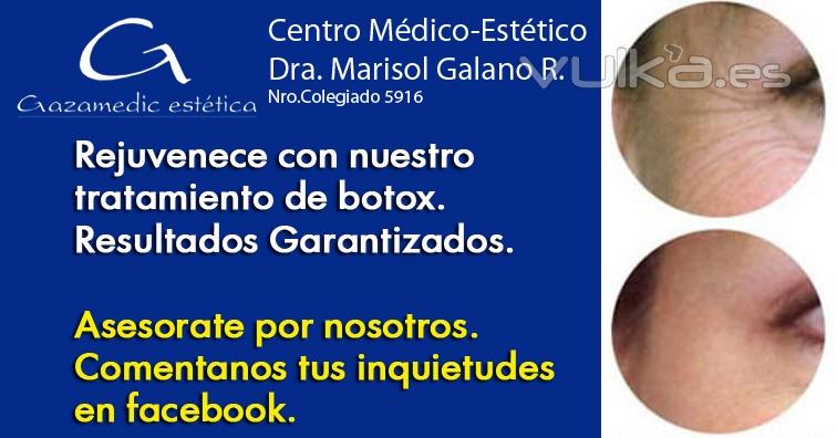 Botox rejuvenecimiento facial  - gazamedicestetica.com