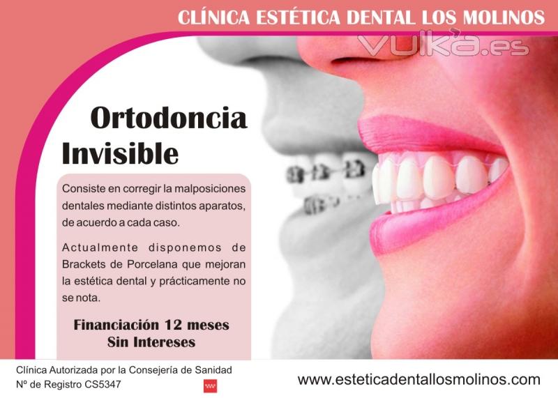 Ortodoncia Esttica,invisible