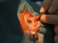 Doctor miguel march extrayendo una catarata con anestesia tpica (gotas).